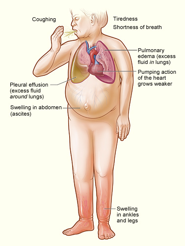 heart failure signs and symptoms_NHLBI